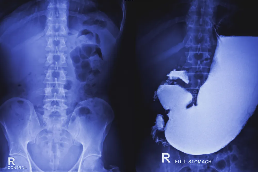 transit oseo gastro duodenal